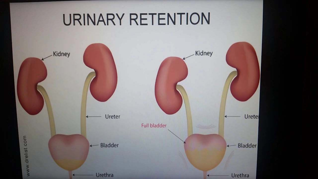 How to Travel with Urinary Retention: Tips for a Comfortable Journey