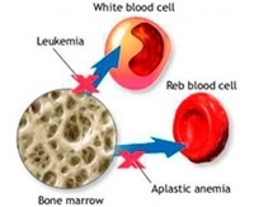 Aplastic Anemia: Understanding the Rare Blood Disorder